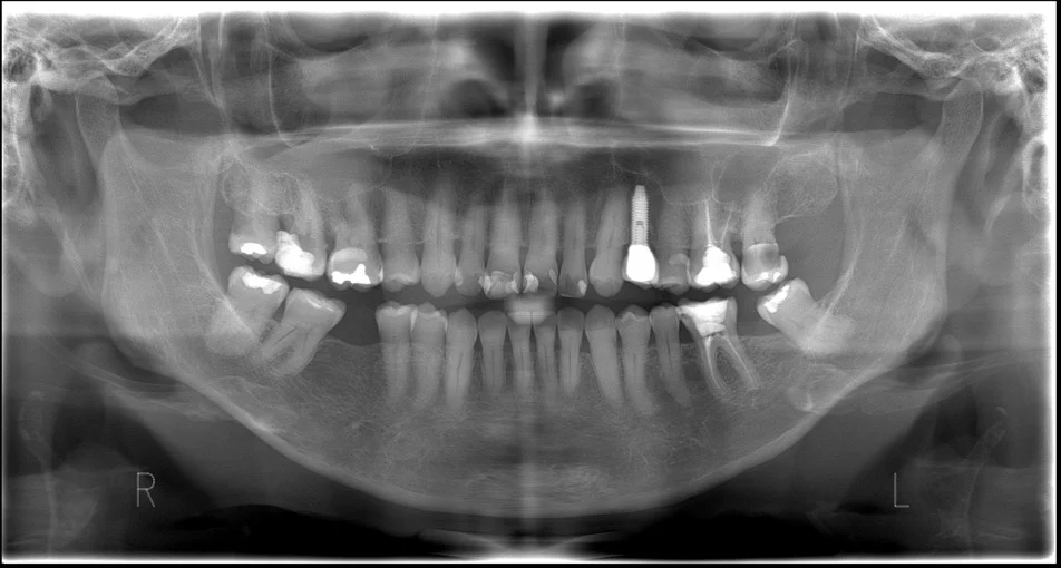 Radiografia panorâmica real usada nesta demonstração